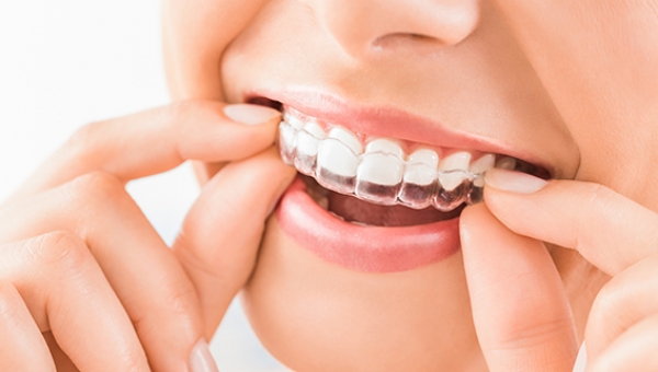 INVISALINGN® : l'apparecchio invisibile per i denti