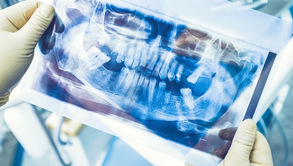 Impianto dentale e dolore: fa male mettere un impianto dentale?