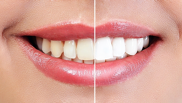 Sbiancamento dentale: cosa è e come funziona