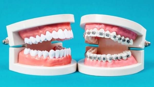 Quali tipi di apparecchio per i denti esistono?